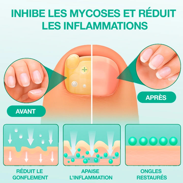 Dermisya® – Patch antifongique pour mycose de l’ongle