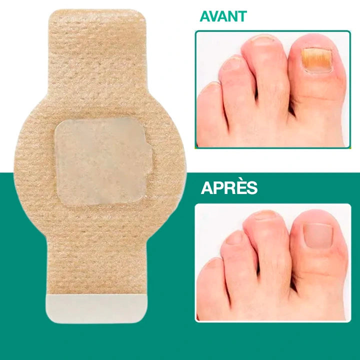 Dermisya® – Patch antifongique pour mycose de l’ongle