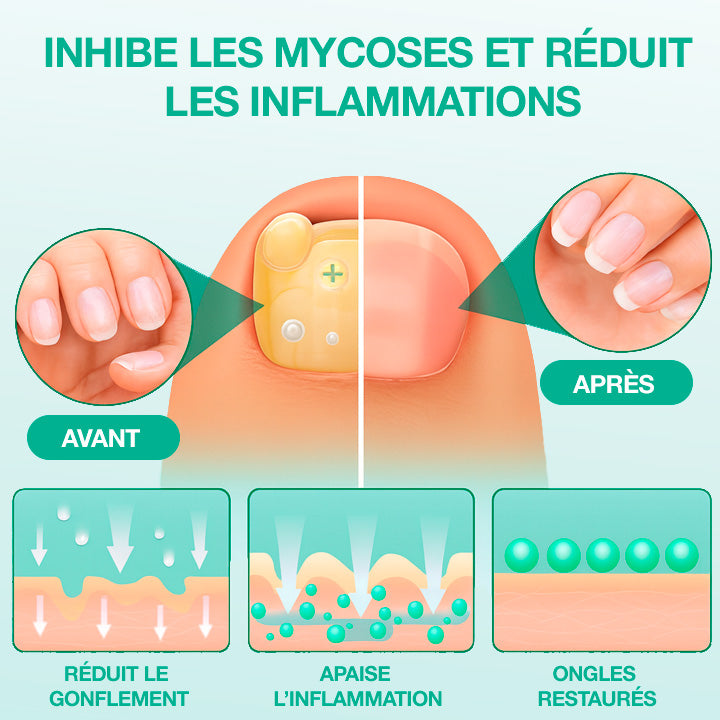 Dermisya® – Le traitement avancé contre les mycoses des ongles