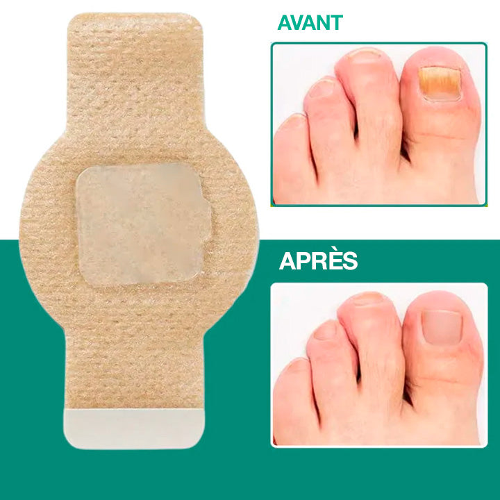 Dermisya® – Le traitement avancé contre les mycoses des ongles