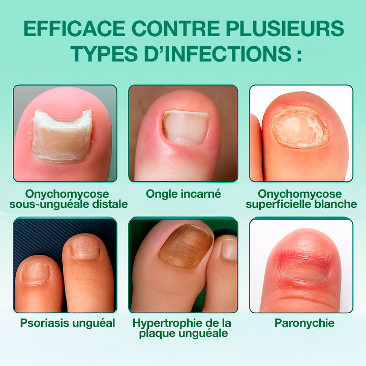Dermisya® – Le traitement avancé contre les mycoses des ongles