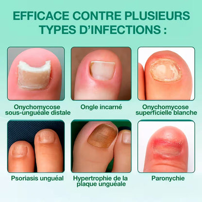 Dermisya® — Patch Antifongique Nocturne